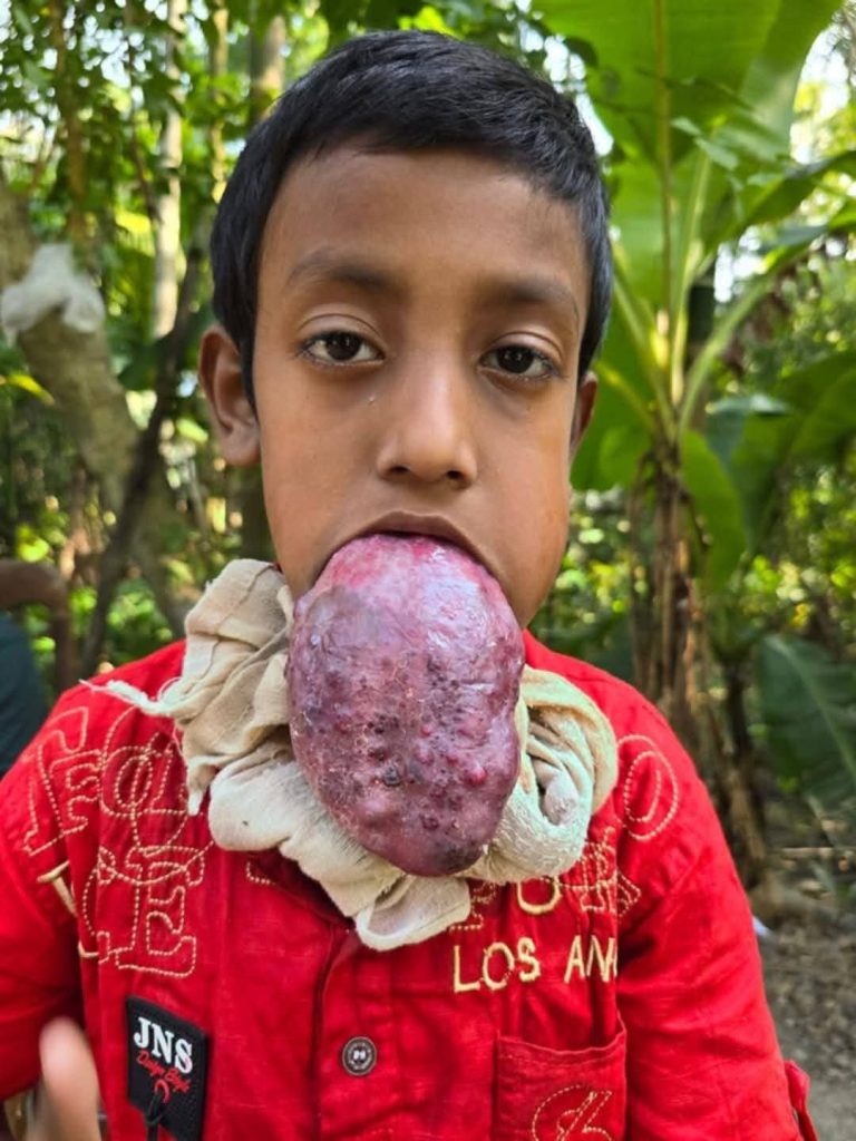 ম্যাক্রোগ্লসিয়ায় আক্রান্ত হওয়ার সম্ভাব্য কারণ গুলো কী?